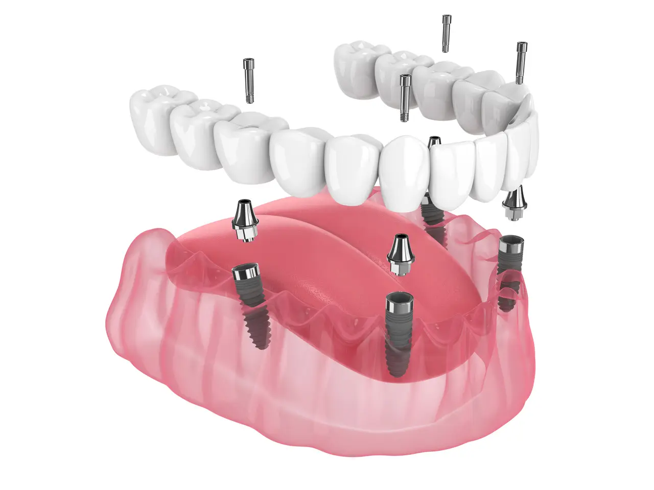 Full Arch / All-on-4 Reconstruction — Merrifield Oral Surgery