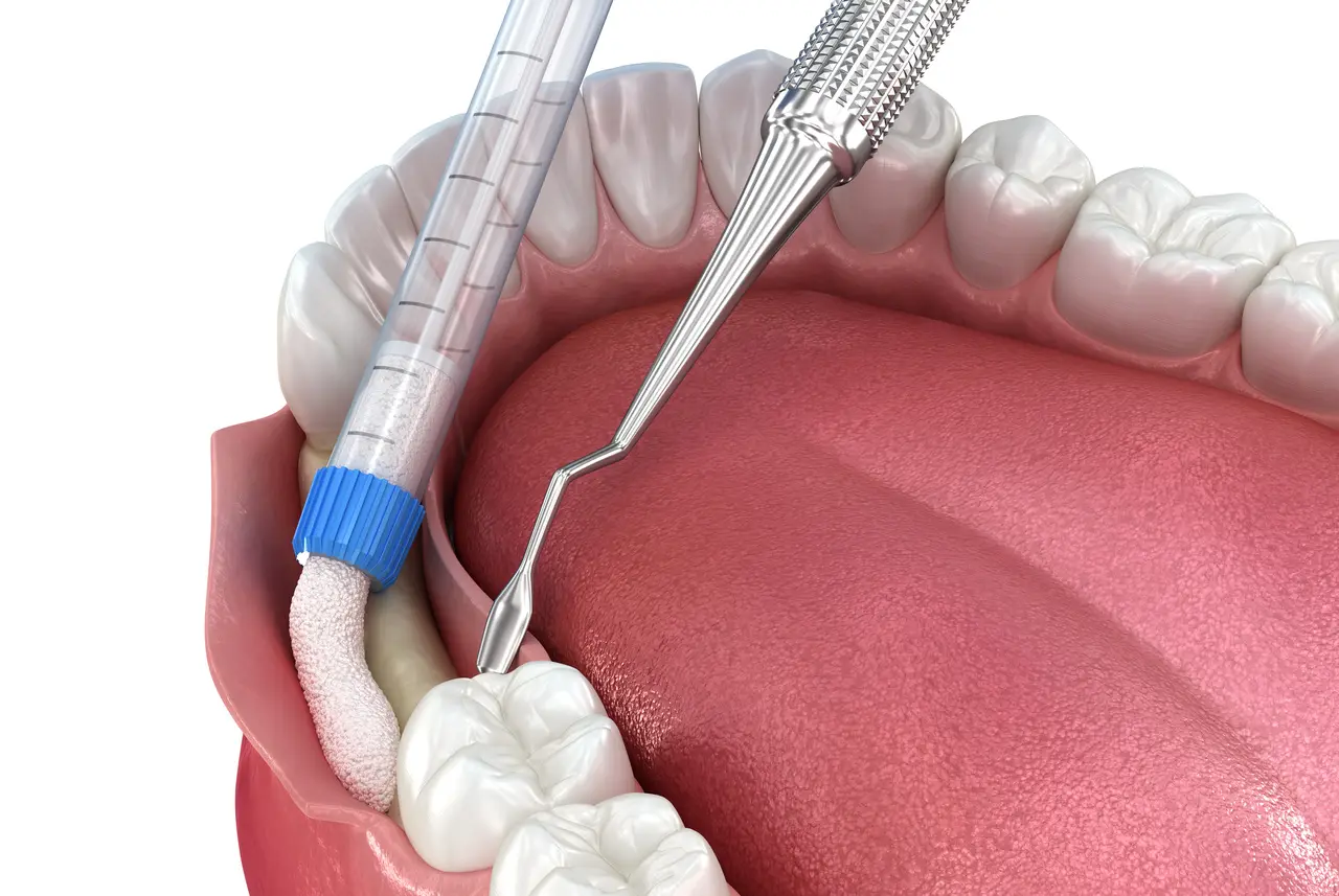 Bone Grafting — Merrifield Oral Surgery