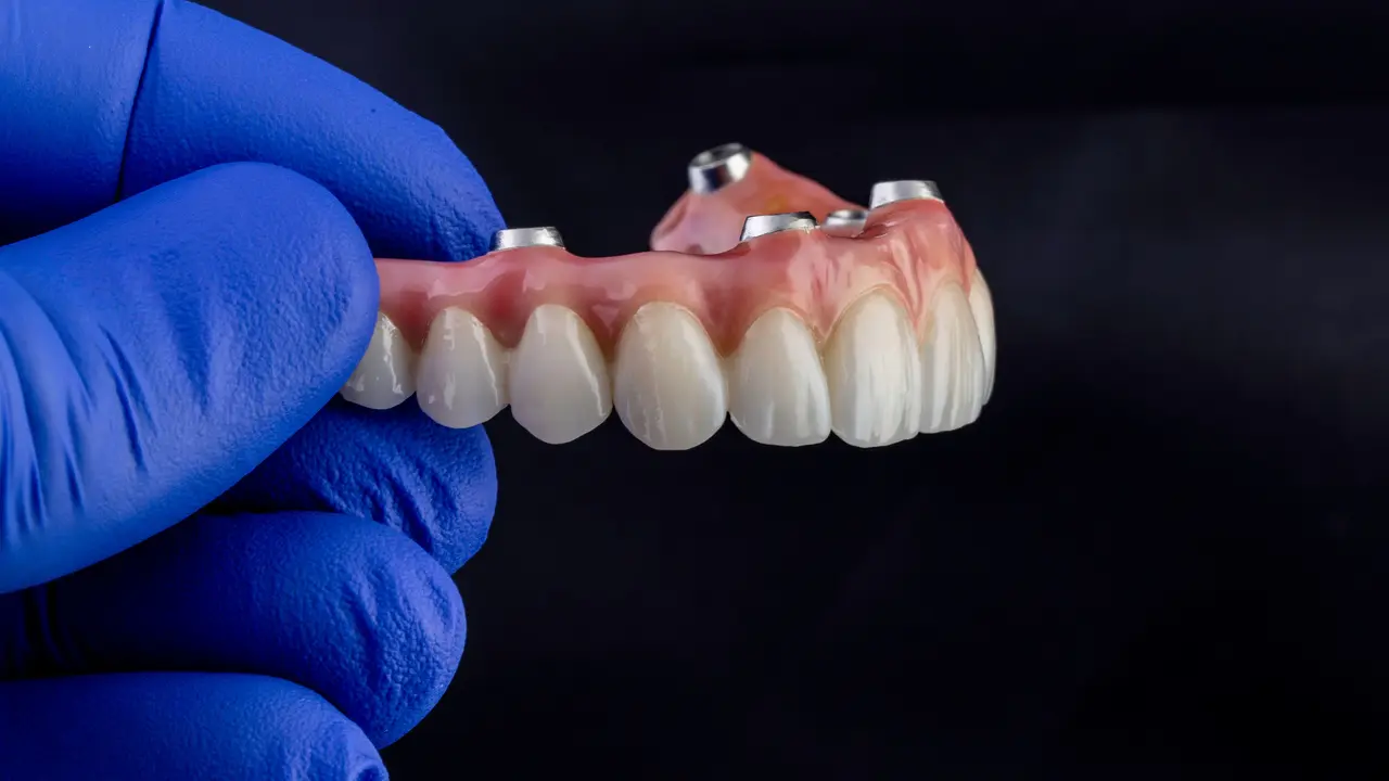Dentaduras Sobre Implantes — Merrifield Oral Surgery