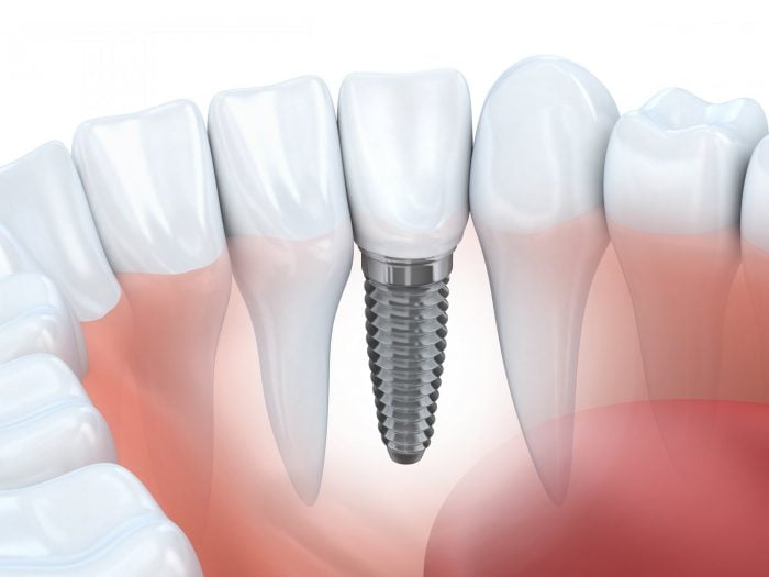 Ilustración de un solo implante dental en la mandíbula inferior