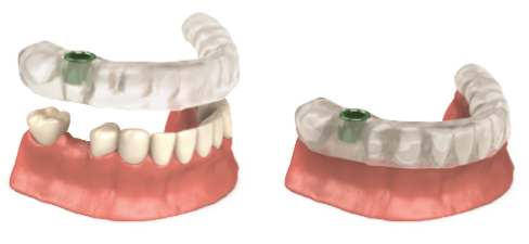 Imagen de una guía de implantes