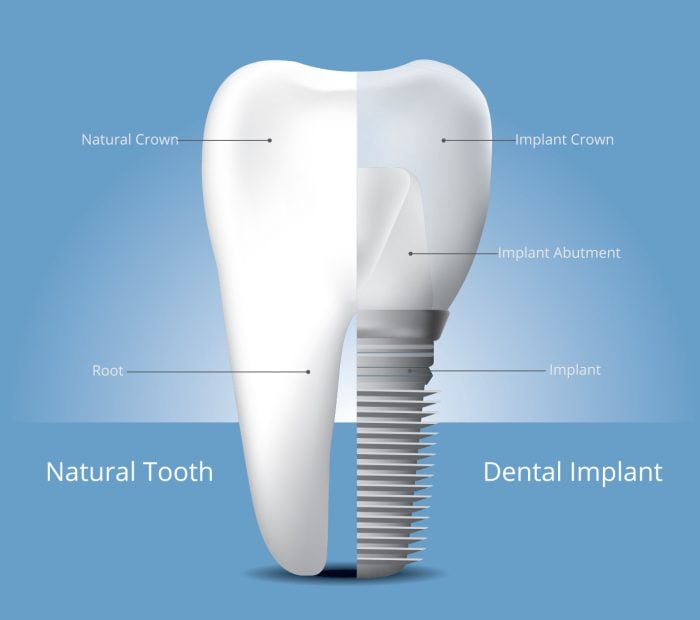 Diagrama de un diente natural frente a un implante dental