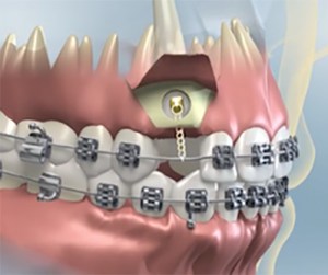 Diagram of impacted canine surgery